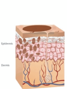Pigmentation Buildup