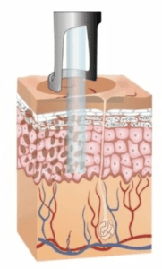 Laser Treatment
