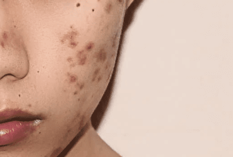 acne scars