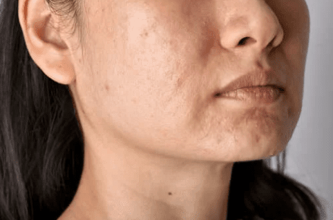 scarred face before pico laser treatment