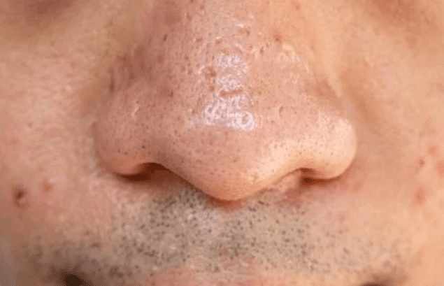 pico laser for large pores