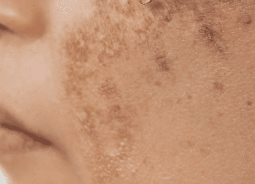 hyperpigmentation