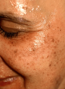skin pigmentation