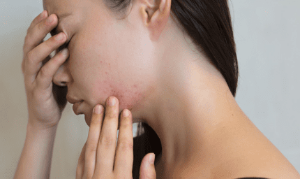 stress acne
