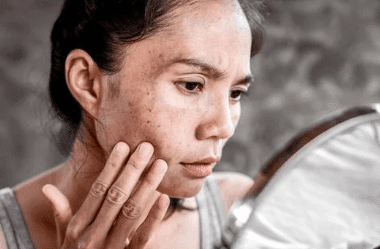 Stubborn pigmentation