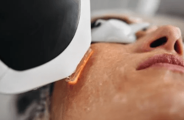 laser for skin pigmentation