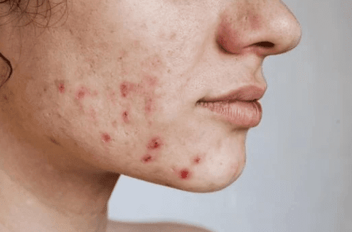 acne scars