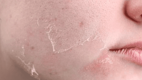 dry and dehydrated skin