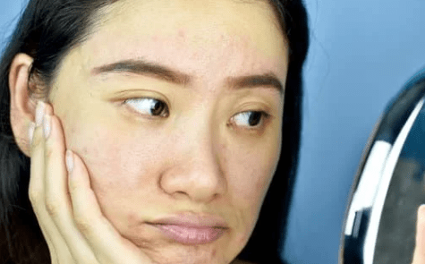 treat dull skin with PDRN RJR healer