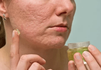 old acne scars