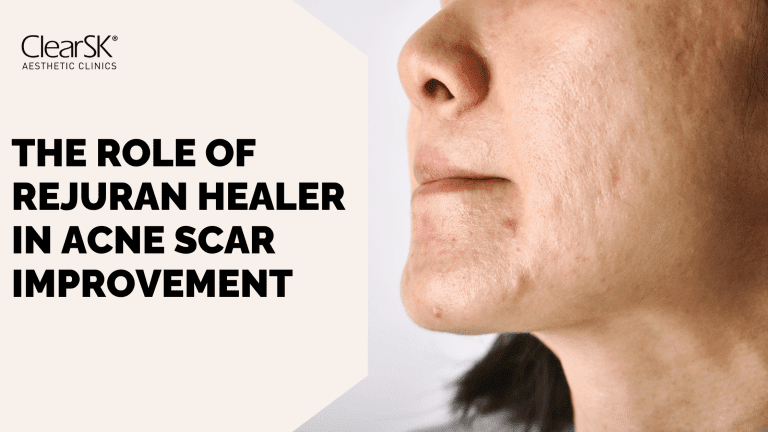 The Role of Rejuran Healer in Acne Scar Improvement