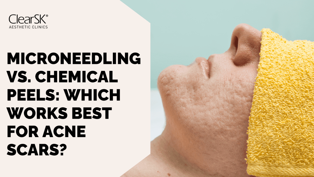 Microneedling vs. Chemical Peels Which Works Best for Acne Scars