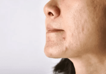 laser resurfacing for acne scars