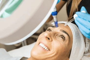 rf microneedling
