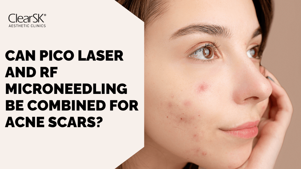 Can Pico Laser and RF Microneedling Be Combined for Acne Scars