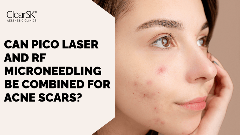 Can Pico Laser and RF Microneedling Be Combined for Acne Scars