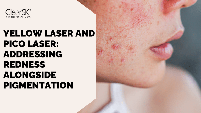 Yellow Laser and Pico Laser: Addressing Redness Alongside Pigmentation