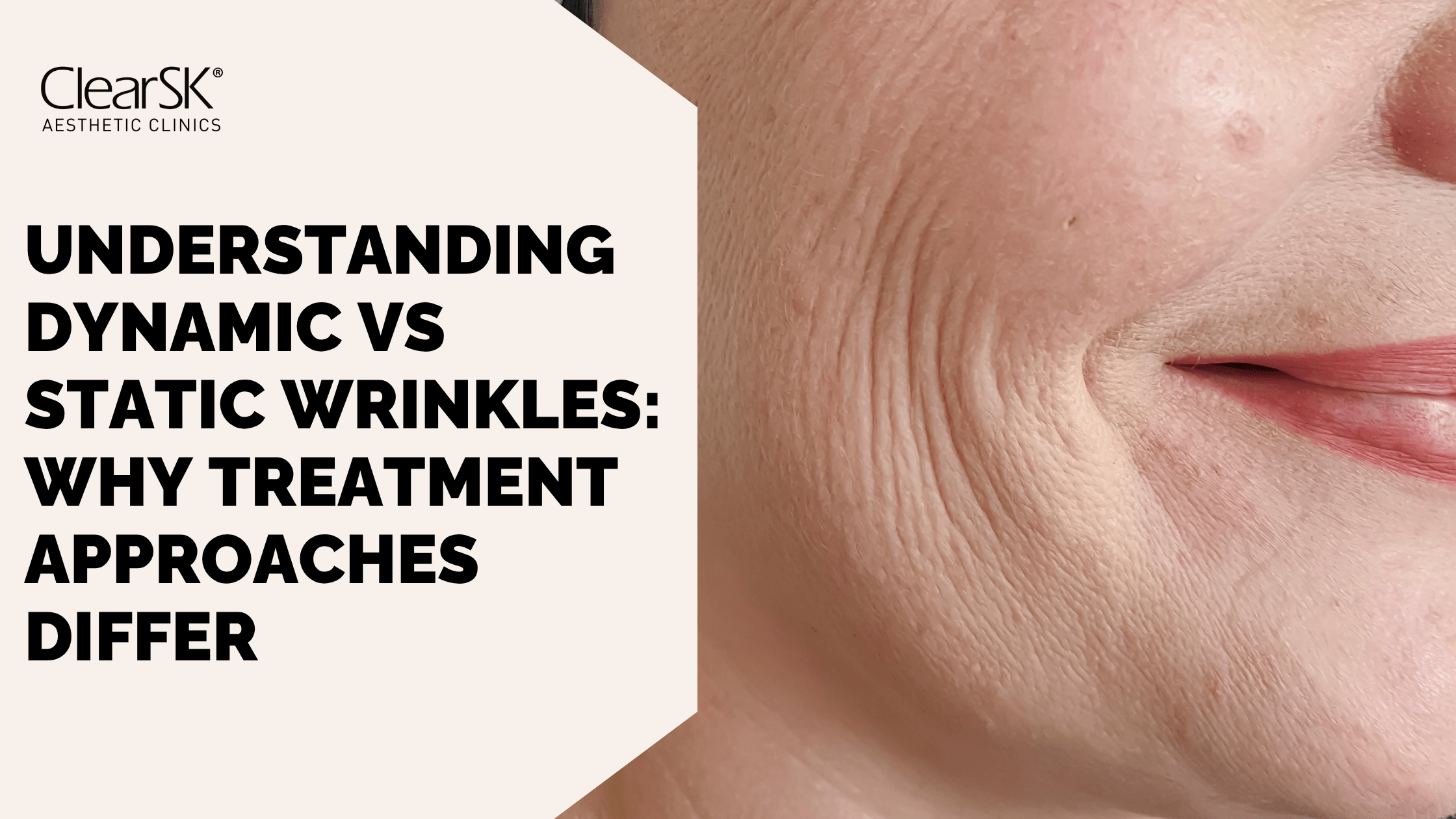 Understanding Dynamic vs Static Wrinkles Why Treatment Approaches Differ