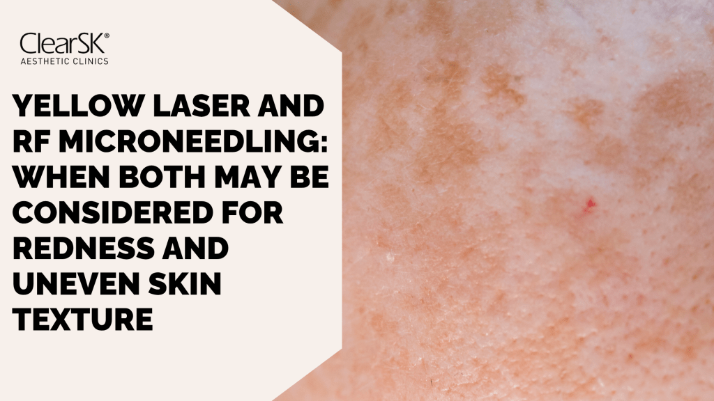 yellow laser and rf microneedling for redness and uneven skin texture